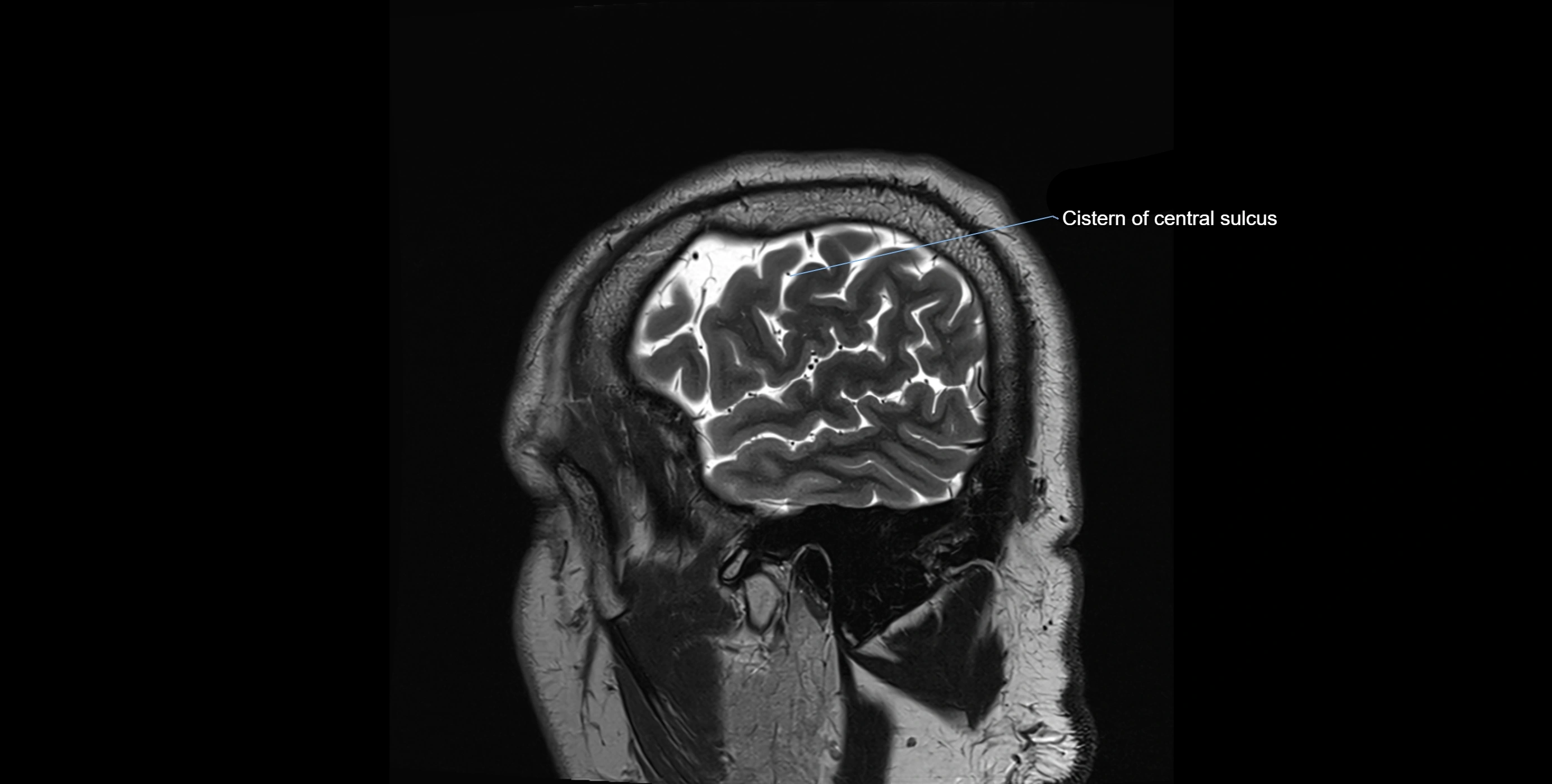 Brain cisterns  and ventricles sagittal anatomy 3T MRI image-img-00001-00004.webp